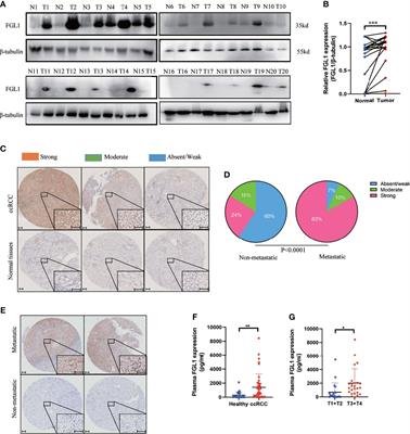 FGL1 as a Novel Mediator and Biomarker of Malignant Progression in Clear Cell Renal Cell Carcinoma